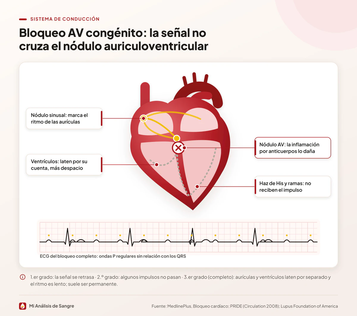 Corazón con el nódulo AV tachado y un ECG de bloqueo auriculoventricular completo, con ondas P sin relación con los QRS